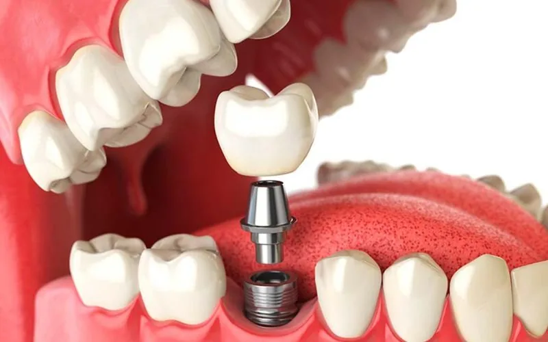 Prótesis dental sobre implante